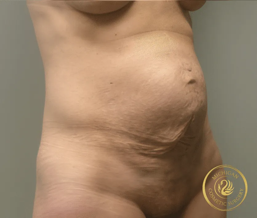 tummy tuck before photo by michigan cosmetic surgery in southfield mi