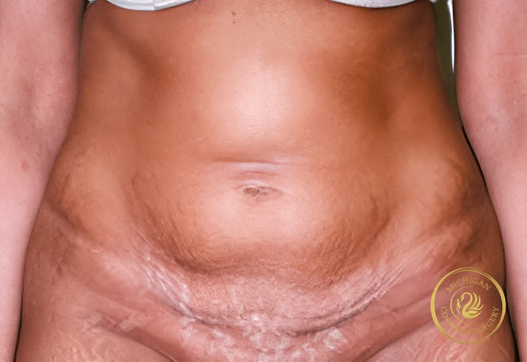 tummy tuck before photo by michigan cosmetic surgery in southfield mi