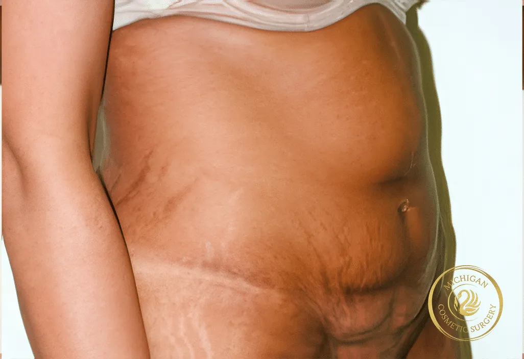 tummy tuck before photo by michigan cosmetic surgery in southfield mi