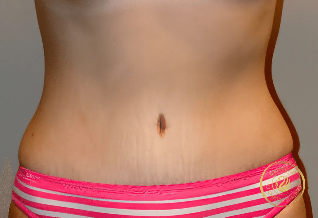 tummy tuck before photo by michigan cosmetic surgery in southfield mi