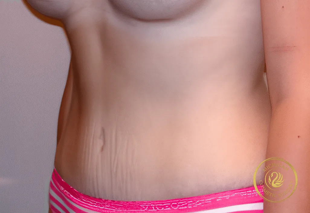 tummy tuck before photo by michigan cosmetic surgery in southfield mi