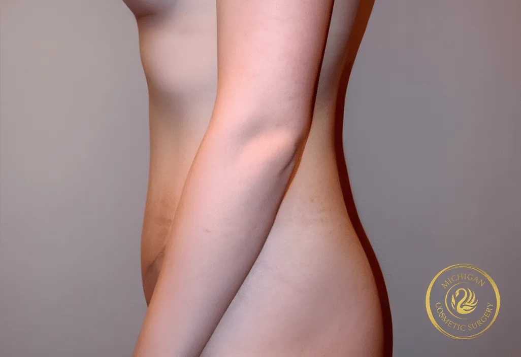 tummy tuck before photo by michigan cosmetic surgery in southfield mi