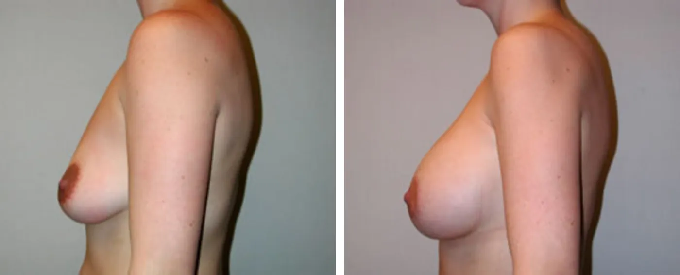 Breast Aug Crescent Periareolar lift c