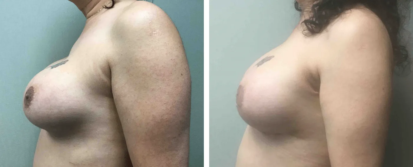 Breast Implant Removal and Replacement in Michigan c