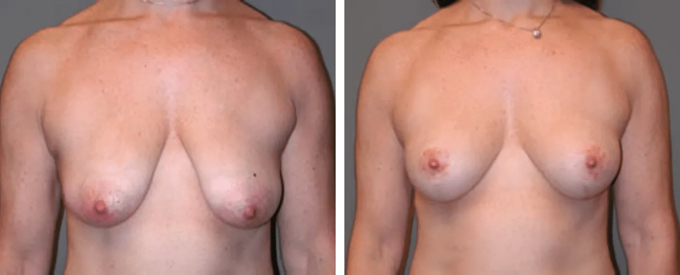 Breast lift a