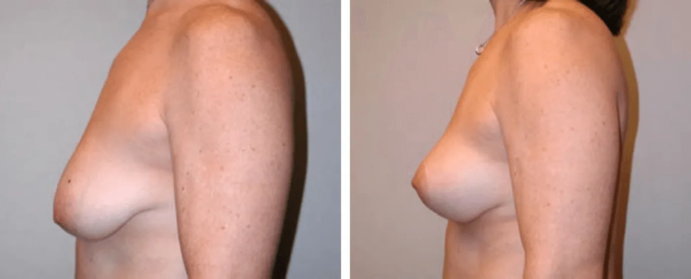 Breast lift c