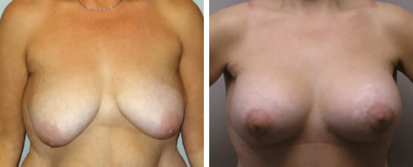 Breast Augmentation with Lollipop Lift c