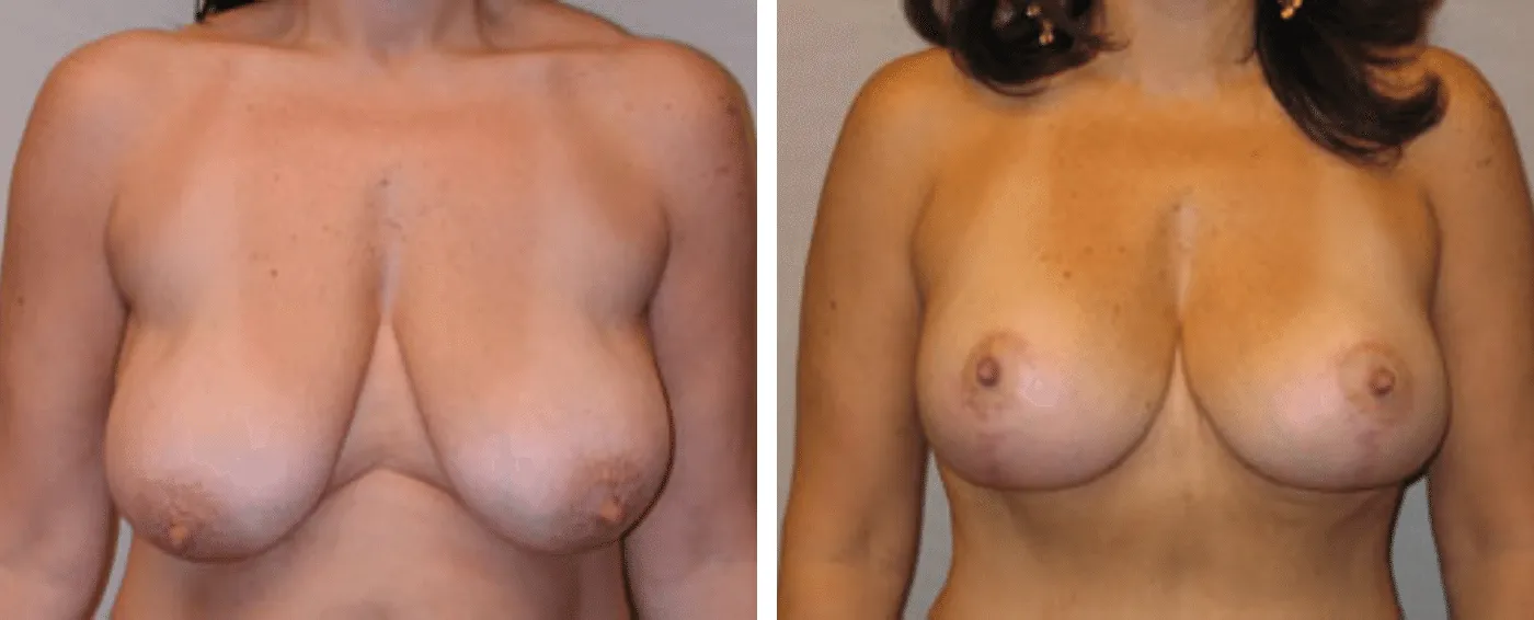 Breast lift a