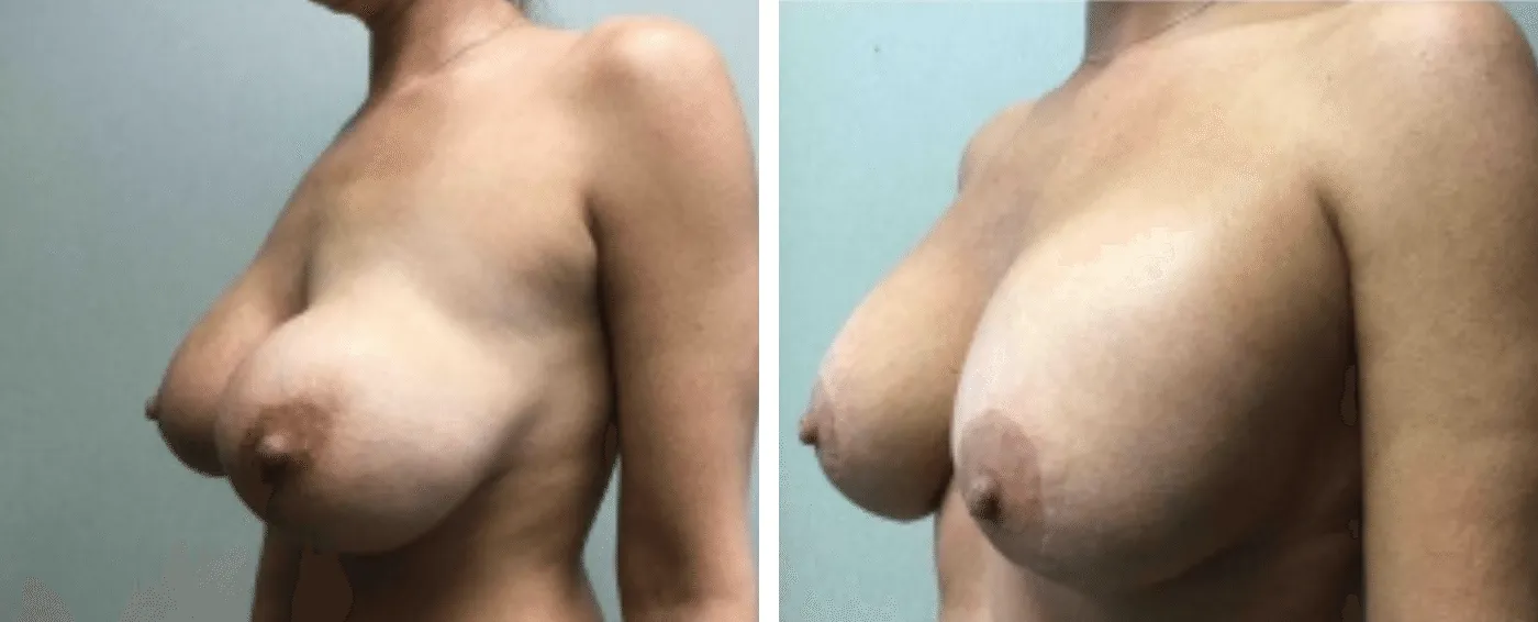 Breast Implant Removal and Replacement in Michigan b