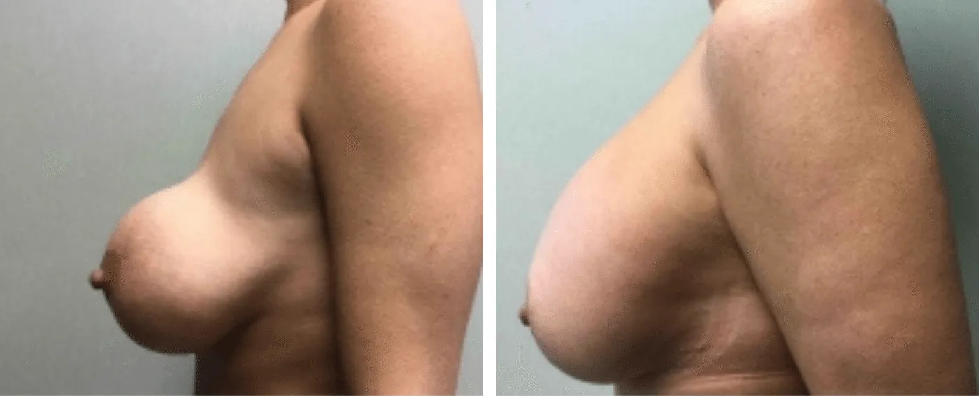 Breast Implant Removal and Replacement in Michigan c