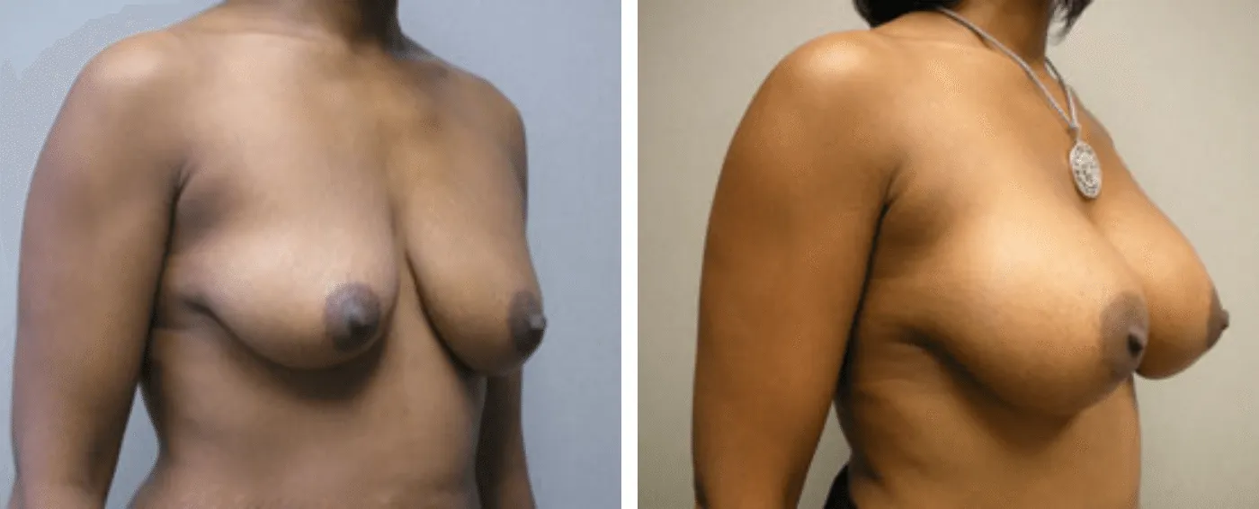 Breast Aug Periareolar lift b