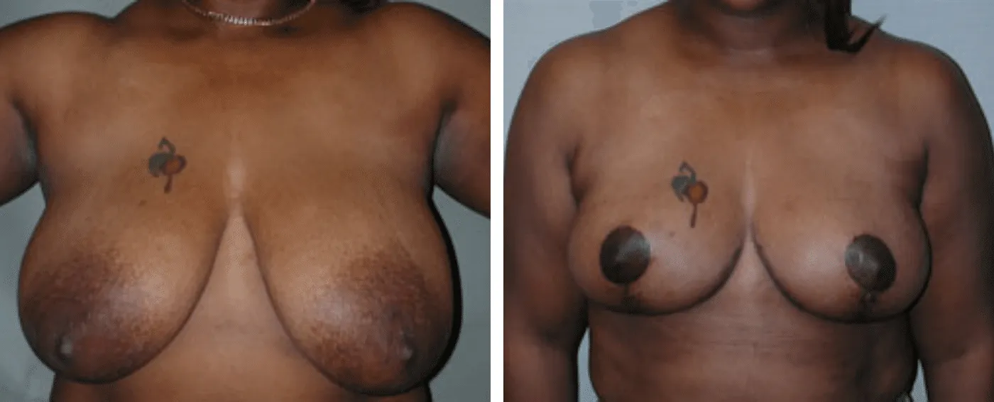 Breast lift a