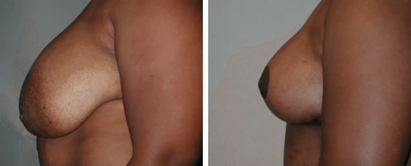 Breast lift c