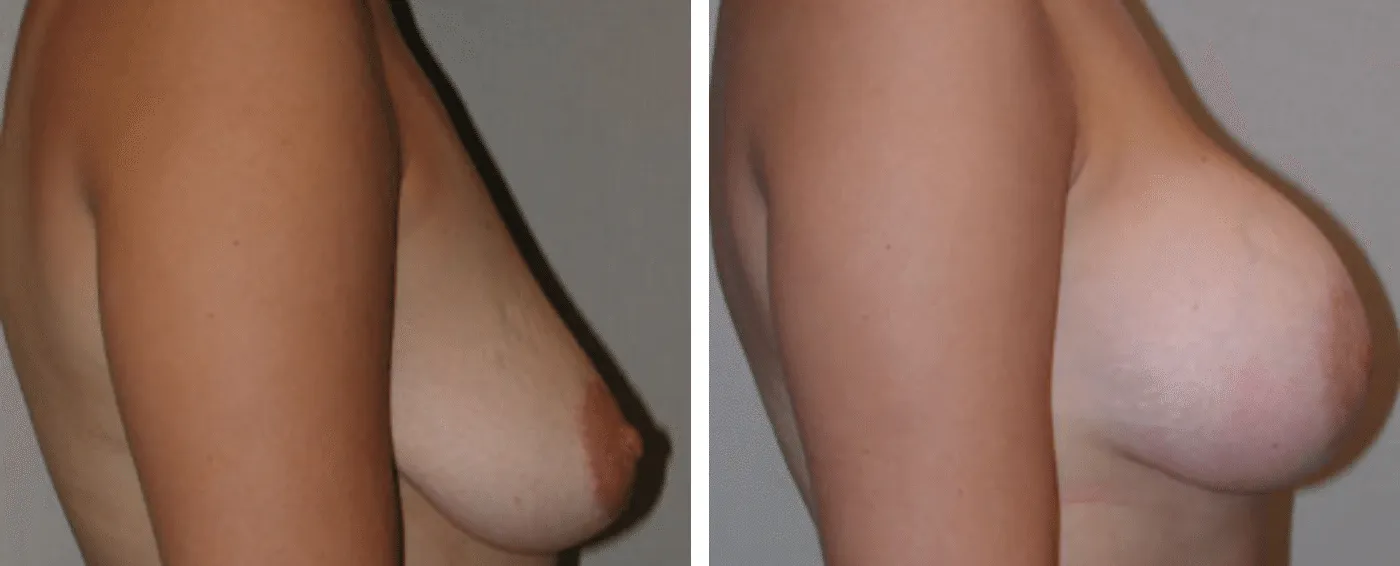 Breast Aug Periareolar lift c