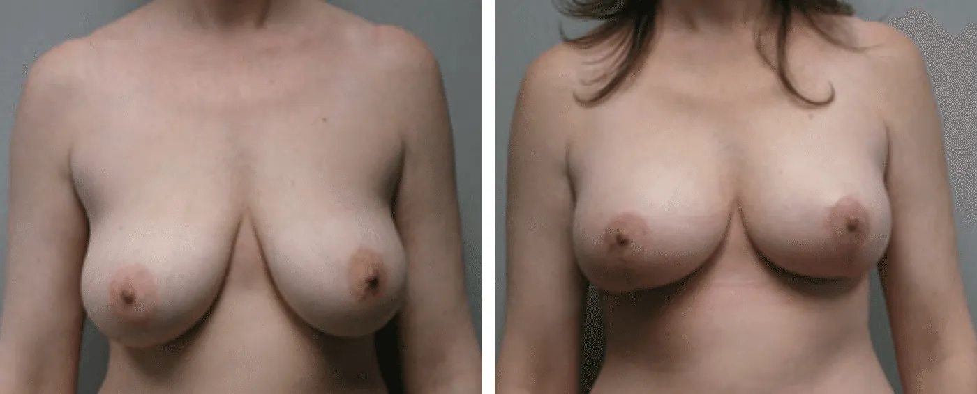 Breast lift a