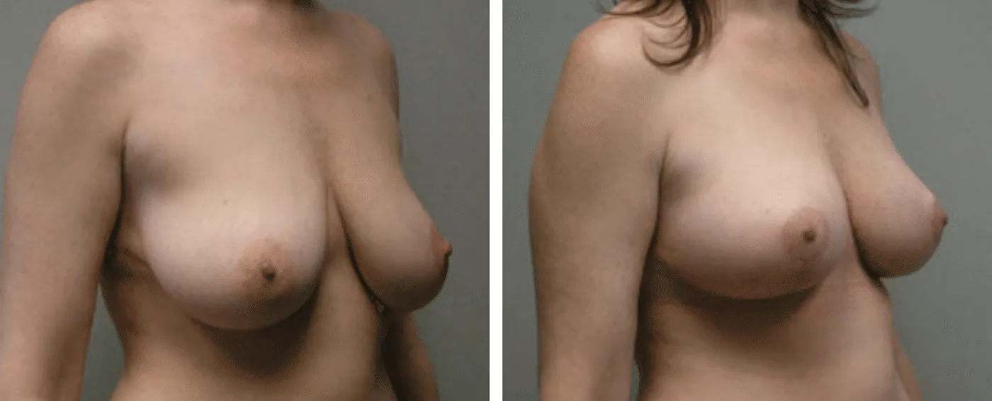 Breast lift b
