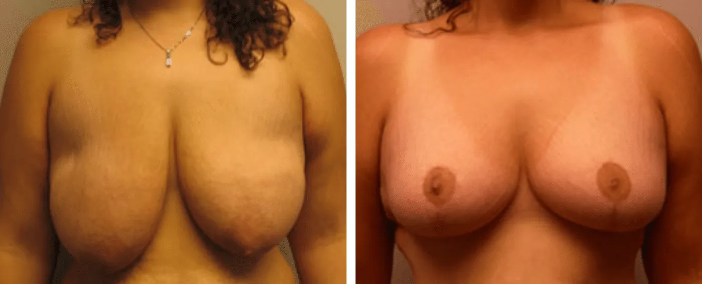 Breast lift a