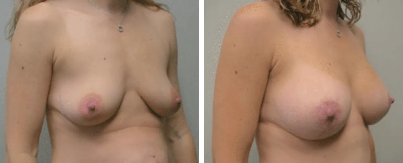 Breast Aug Periareolar lift b