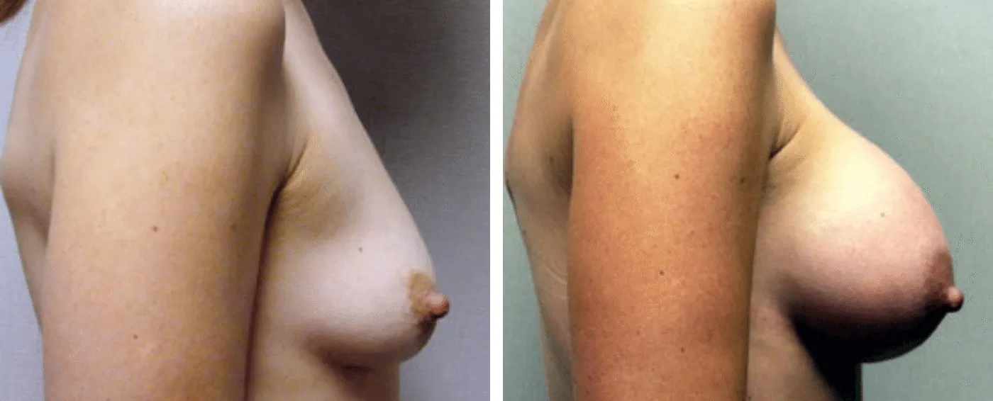 Breast Augmentation with Crescent lift c
