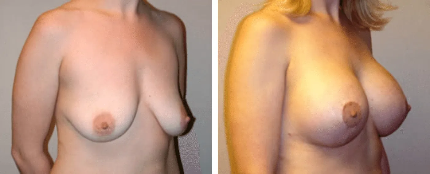 Breast Augmentation with Lollipop Lift b