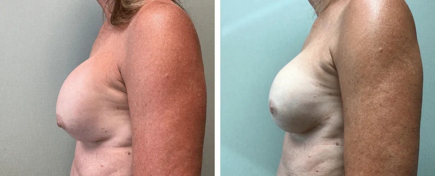 Breast Implant Removal and Replacement in Michigan b