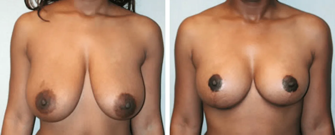 Breast lift a