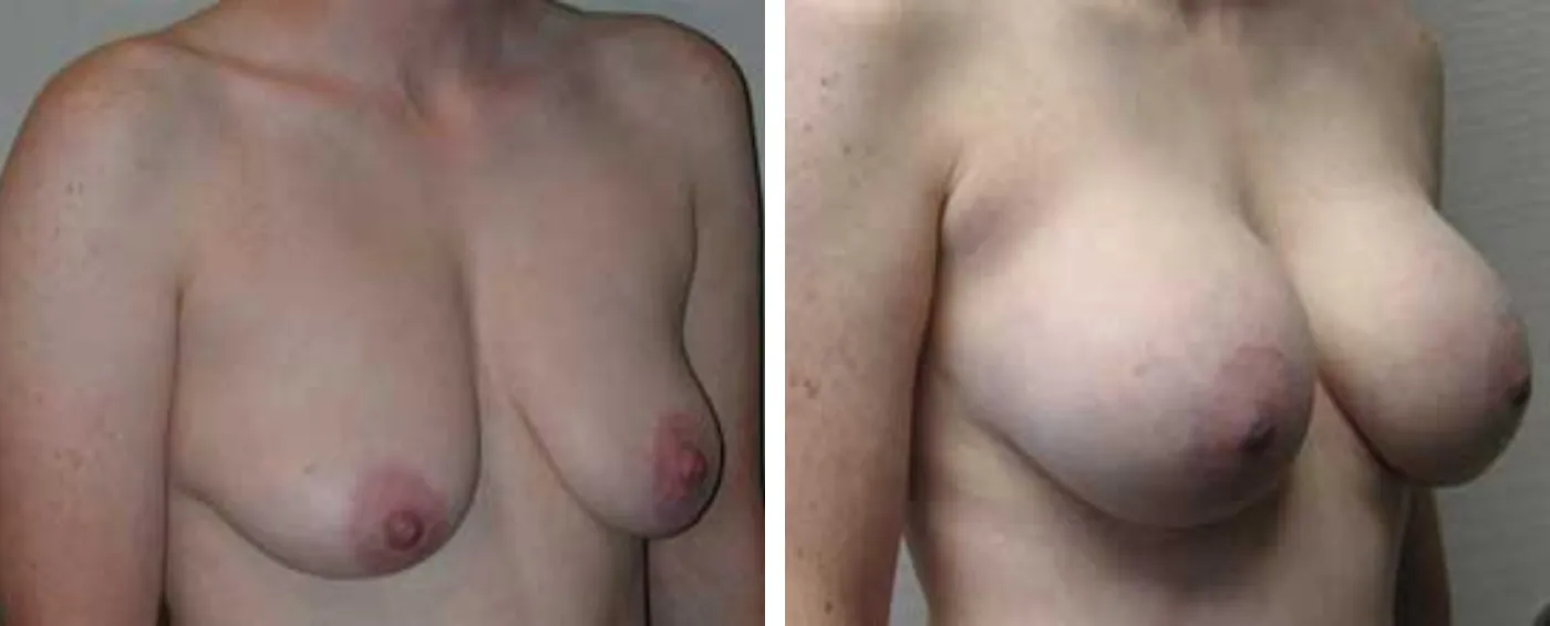 Breast Augmentation with Lollipop Lift b
