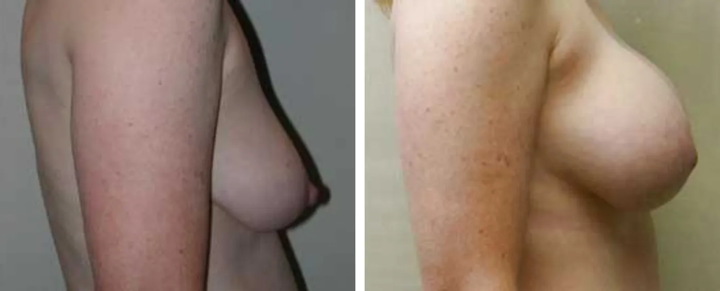 Breast Augmentation with Lollipop Lift c