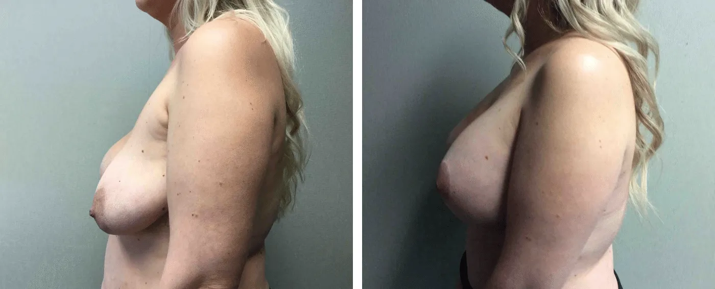 Breast Implant Removal and Replacement in Michigan b