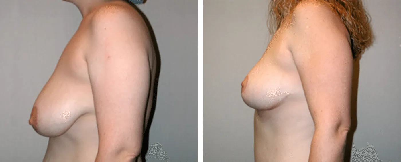 Breast lift c