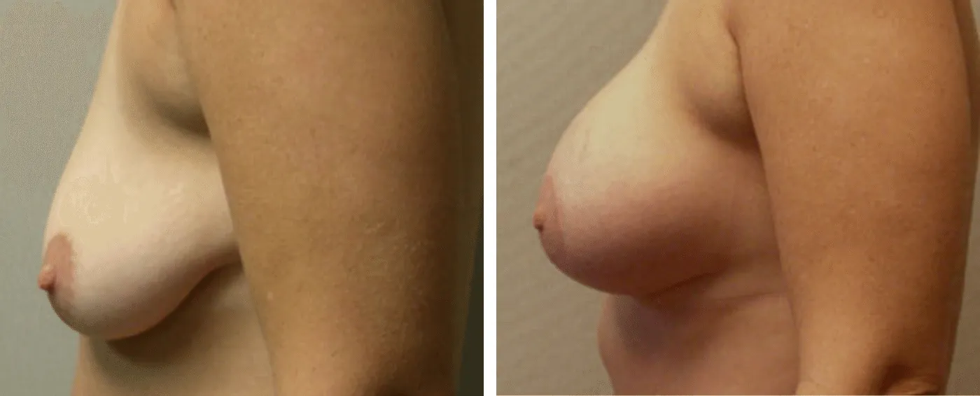 Breast Augmentation with Lollipop Lift c