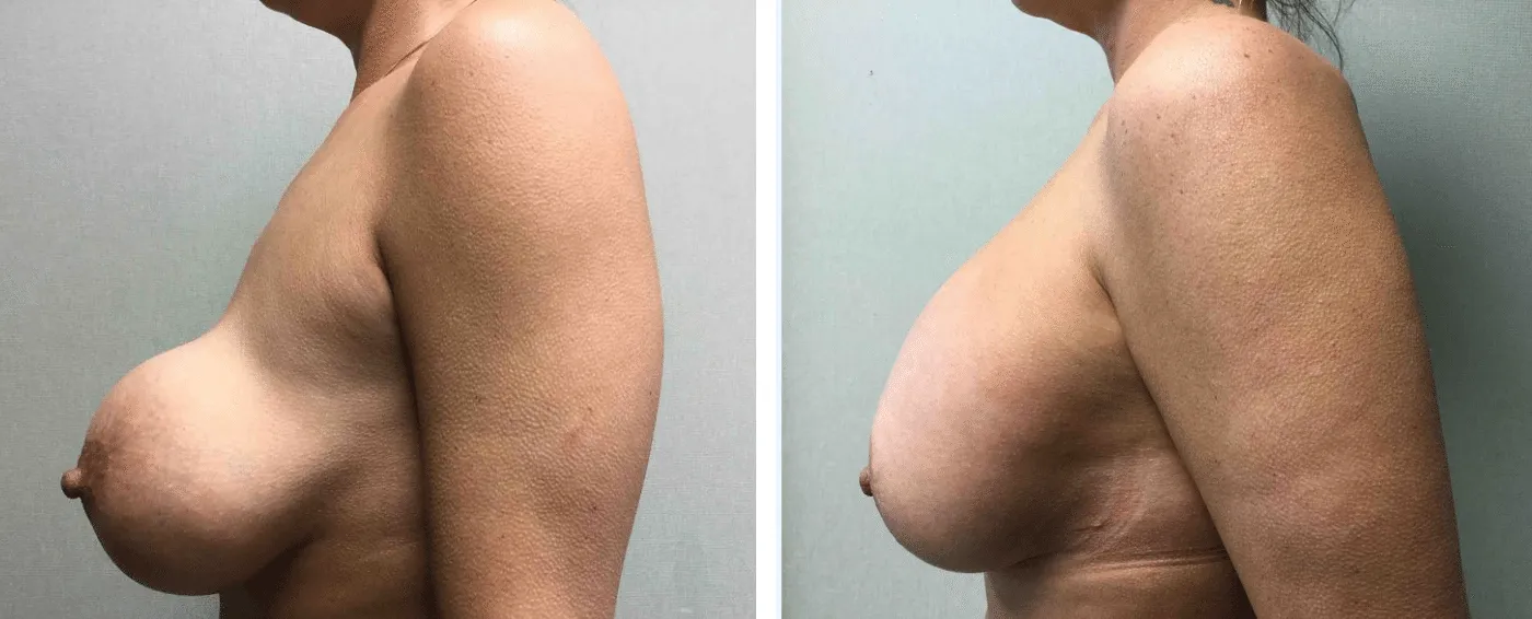 Breast Implant Removal and Replacement in Michigan b