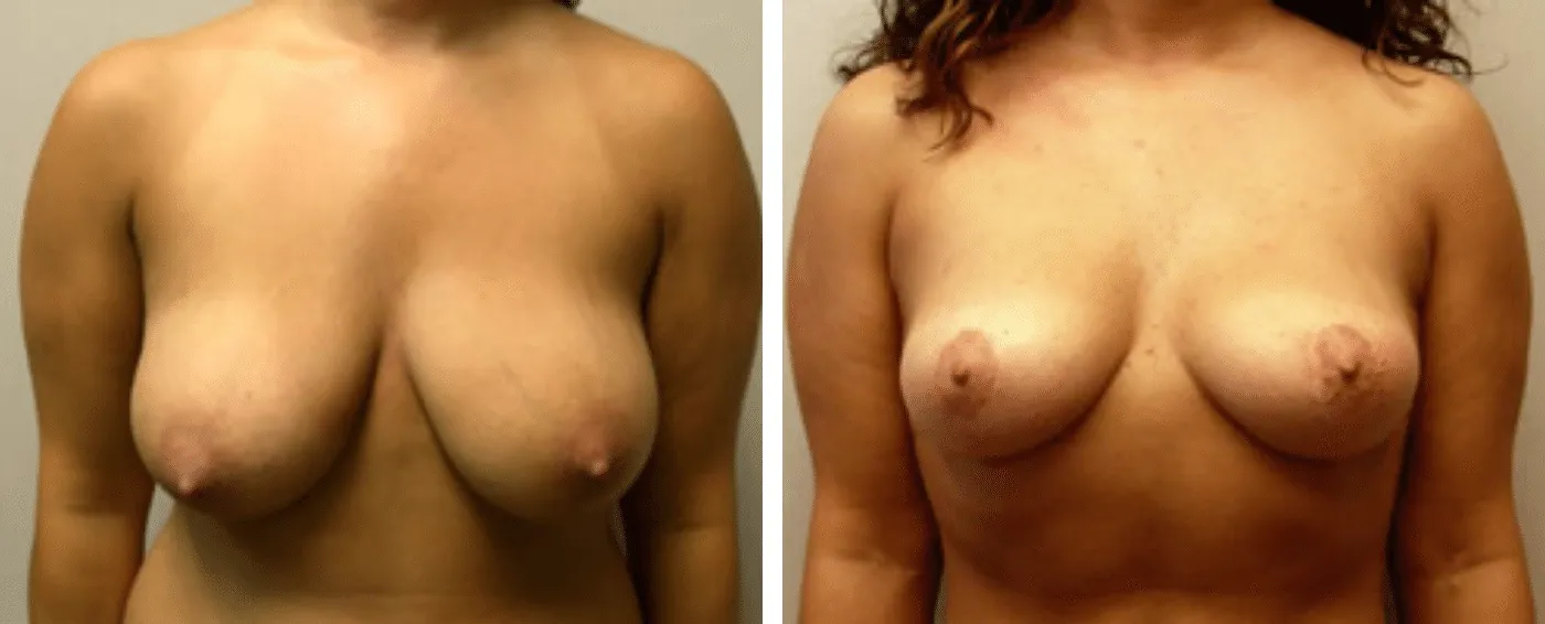 Breast lift a
