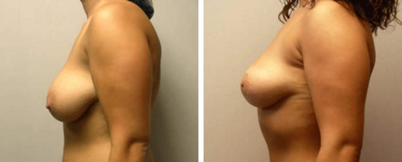Breast lift c