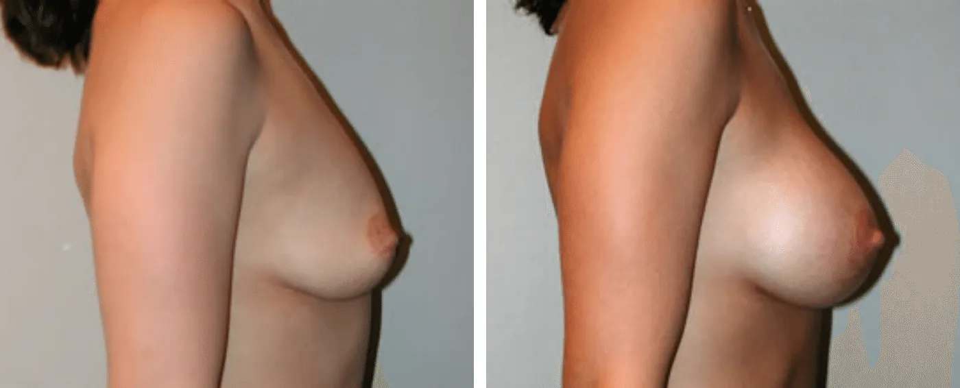 Breast Aug Periareolar lift c