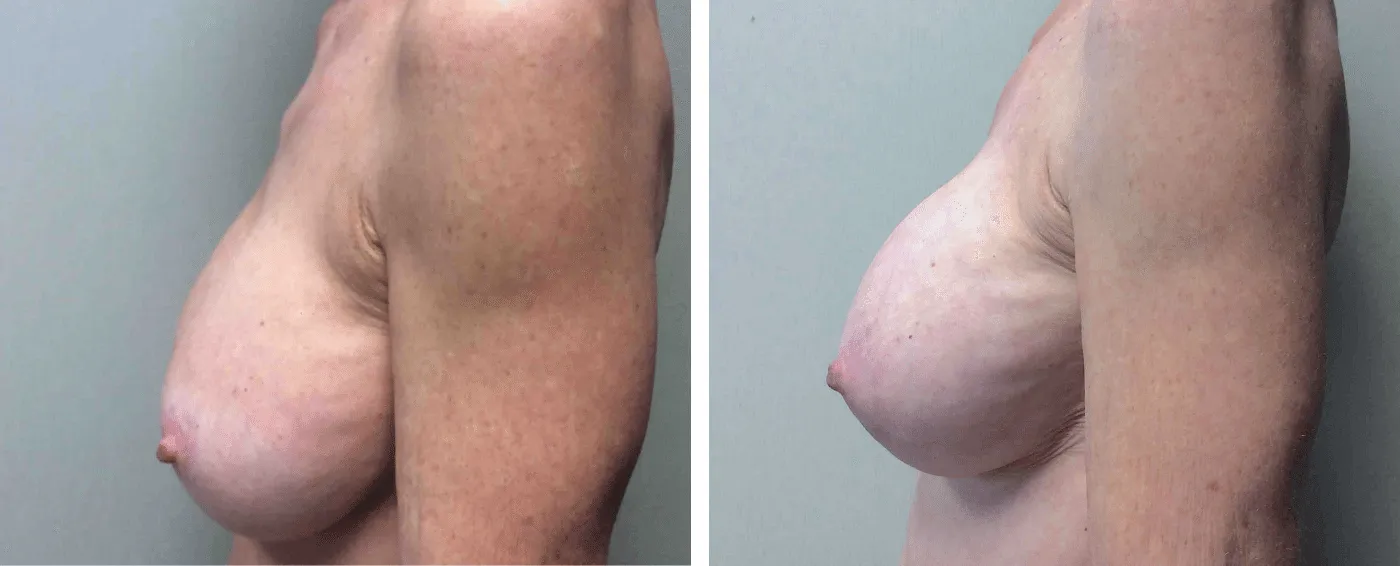 Breast Implant Removal and Replacement in Michigan c