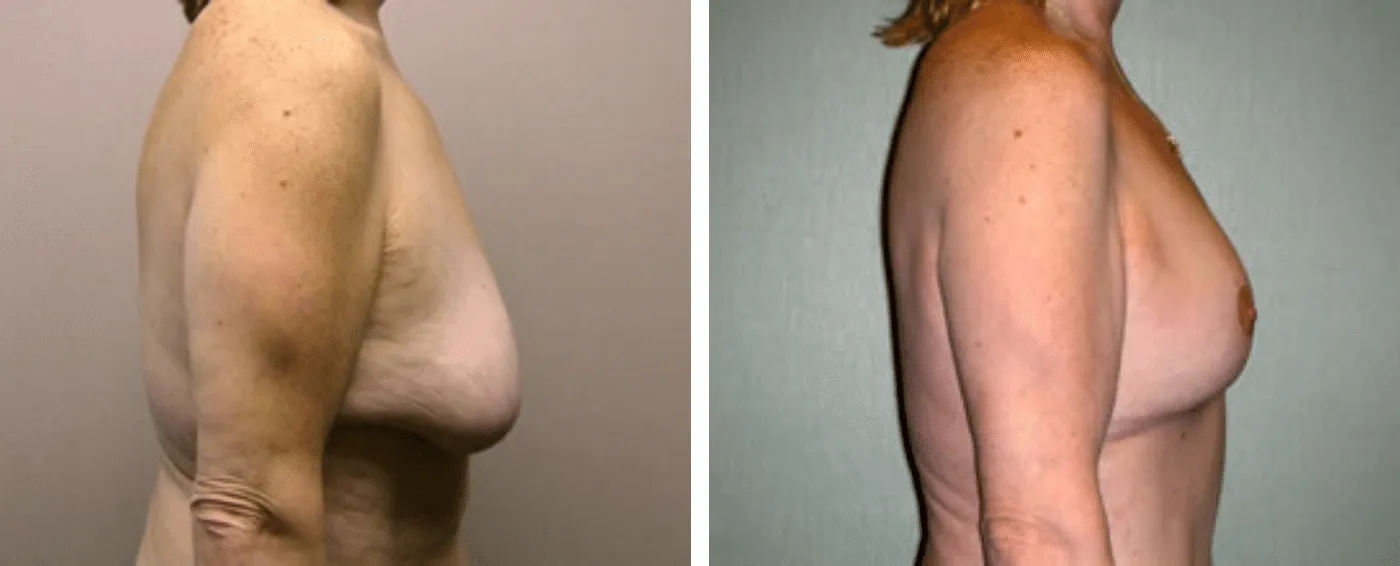 Breast lift c