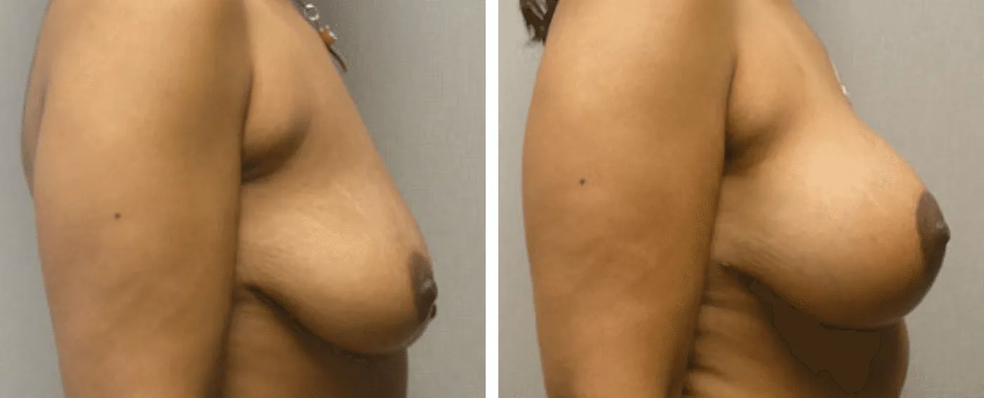 Breast Aug Periareolar lift c