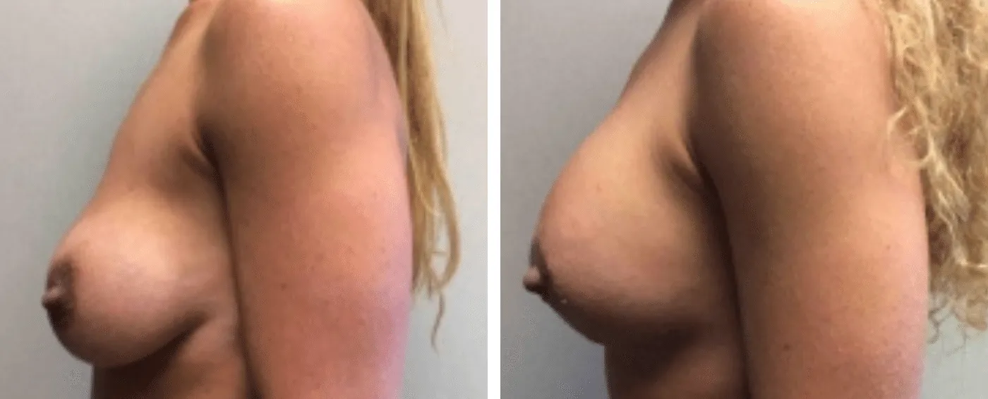 Breast Implant Removal and Replacement in Michigan c