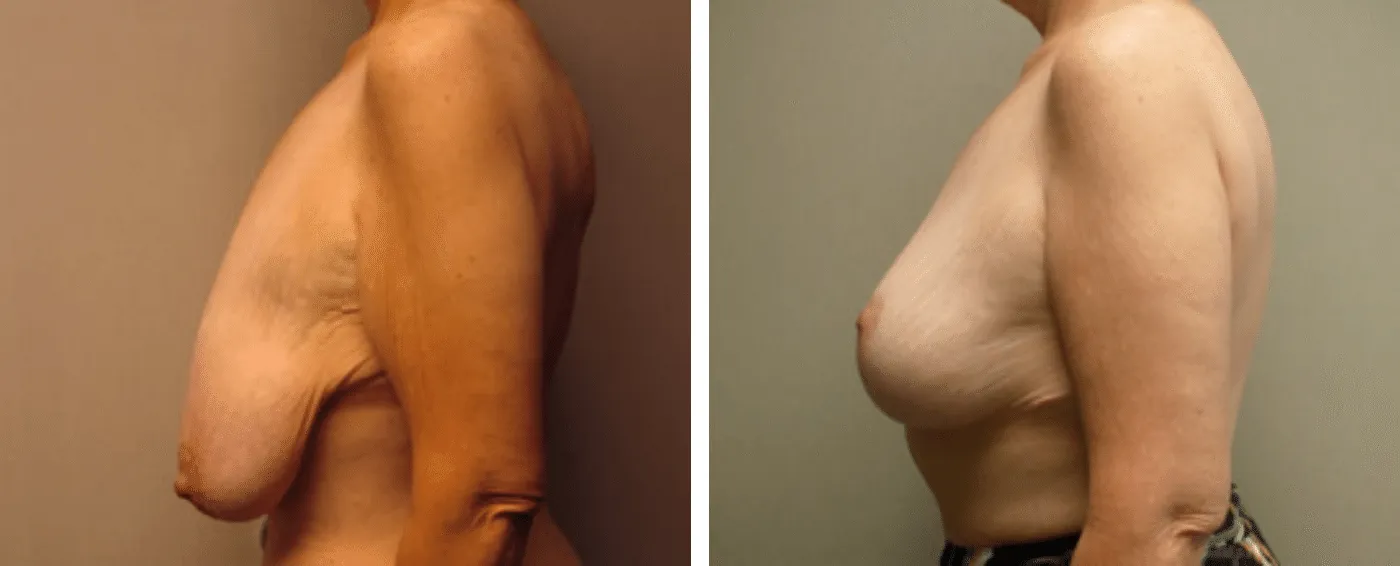 Breast lift c