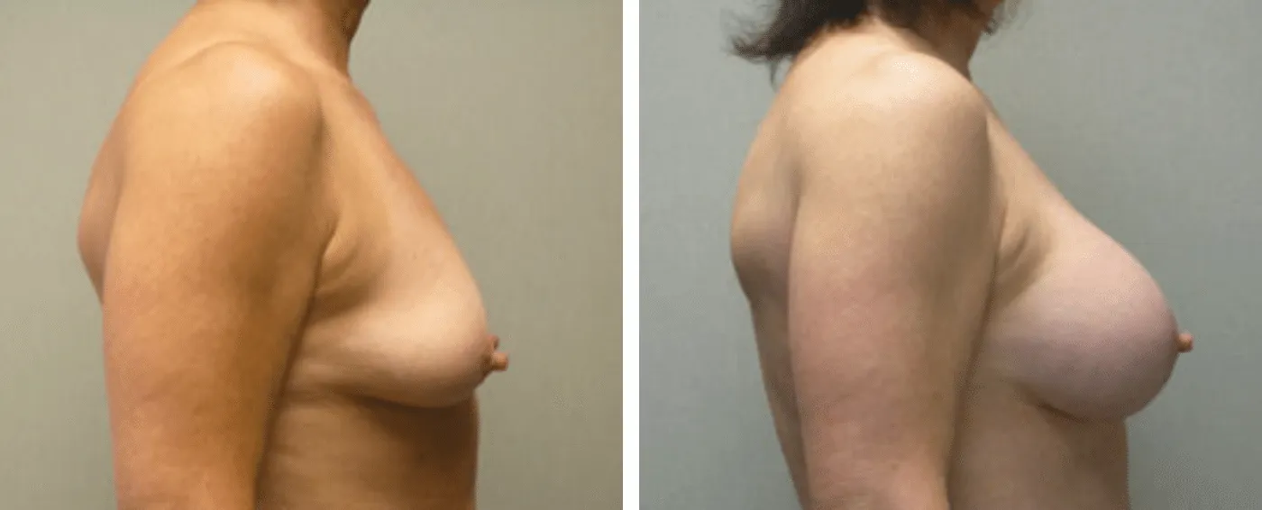 Breast Aug Periareolar lift c