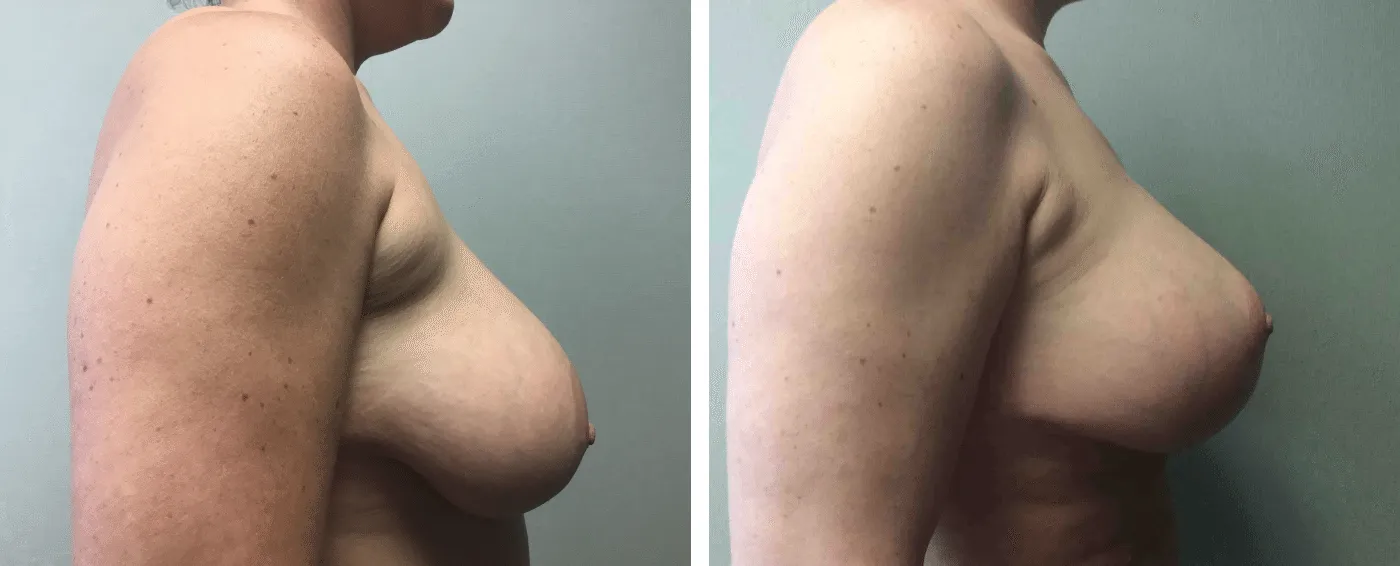 Breast Augmentation with Lollipop Lift c