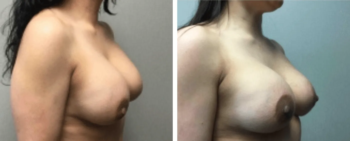 Breast Implant Removal and Replacement in Michigan b