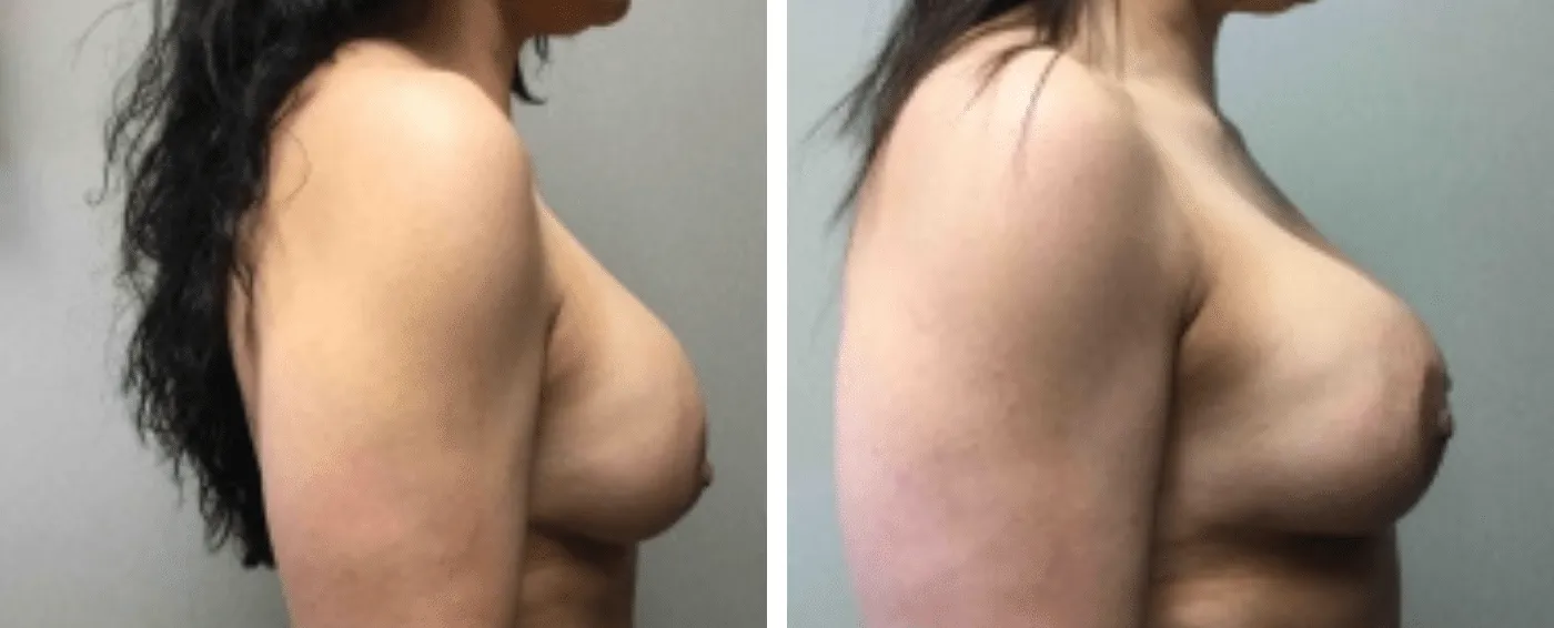 Breast Implant Removal and Replacement in Michigan c