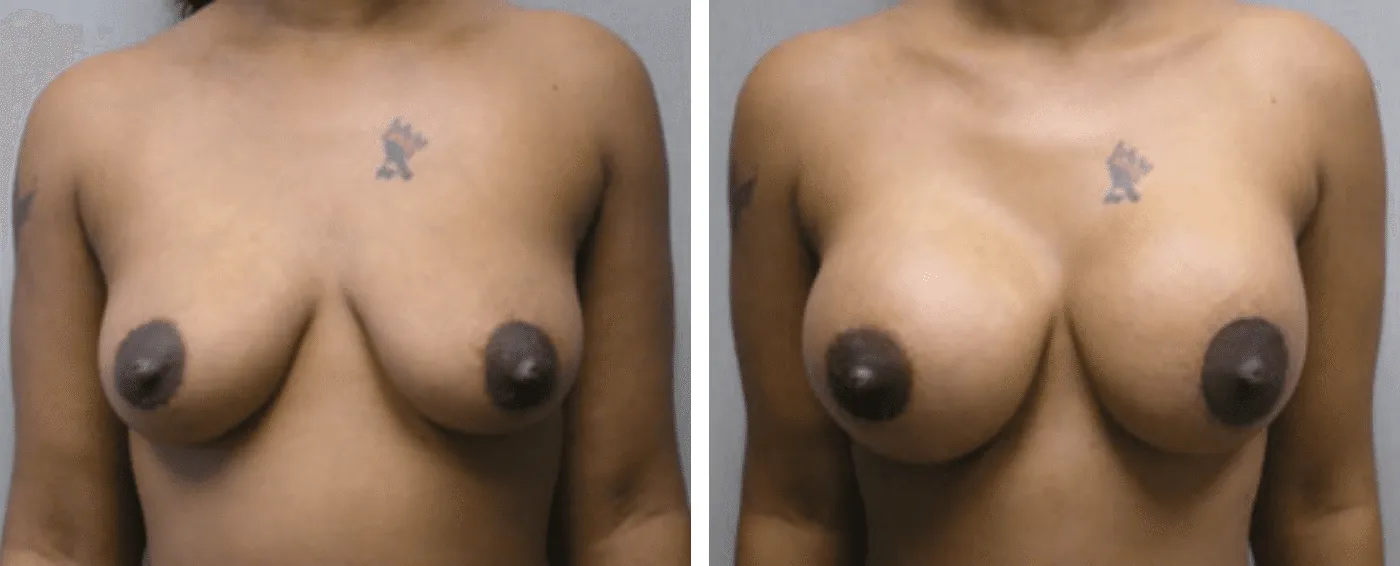 Breast Aug Periareolar lift a