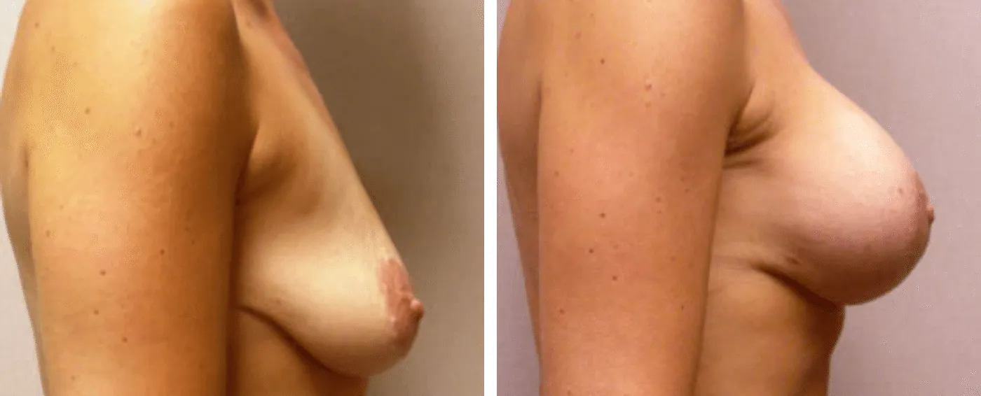 Breast Augmentation with Lollipop Lift c