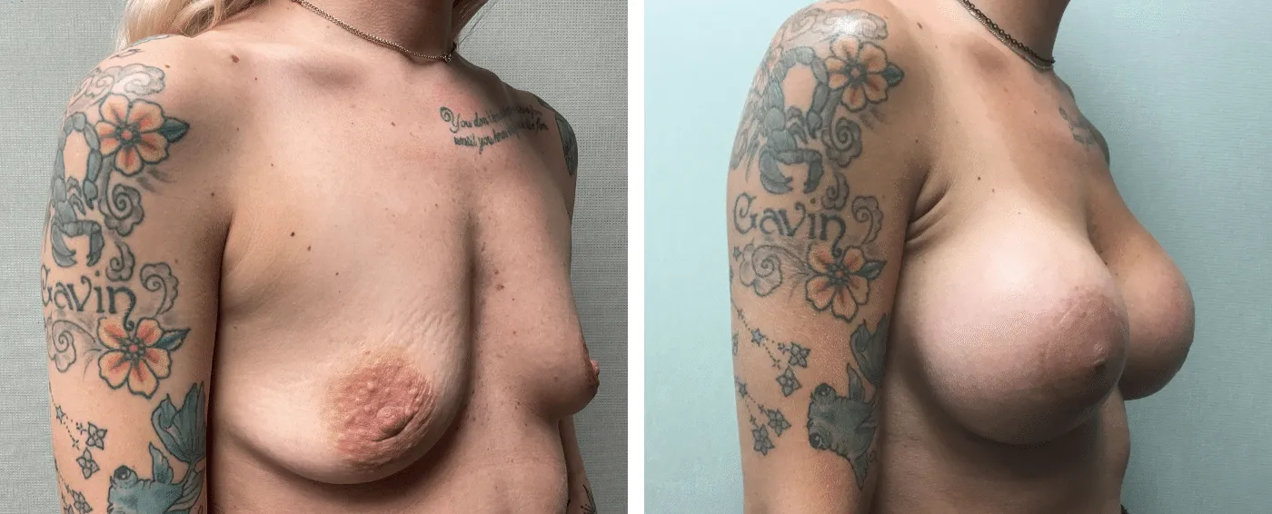 Breast Aug Periareolar lift b