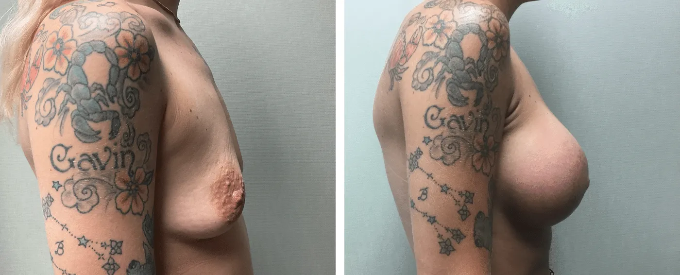 Breast Aug Periareolar lift c
