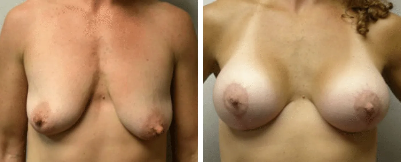 Breast Augmentation with Lollipop Lift a