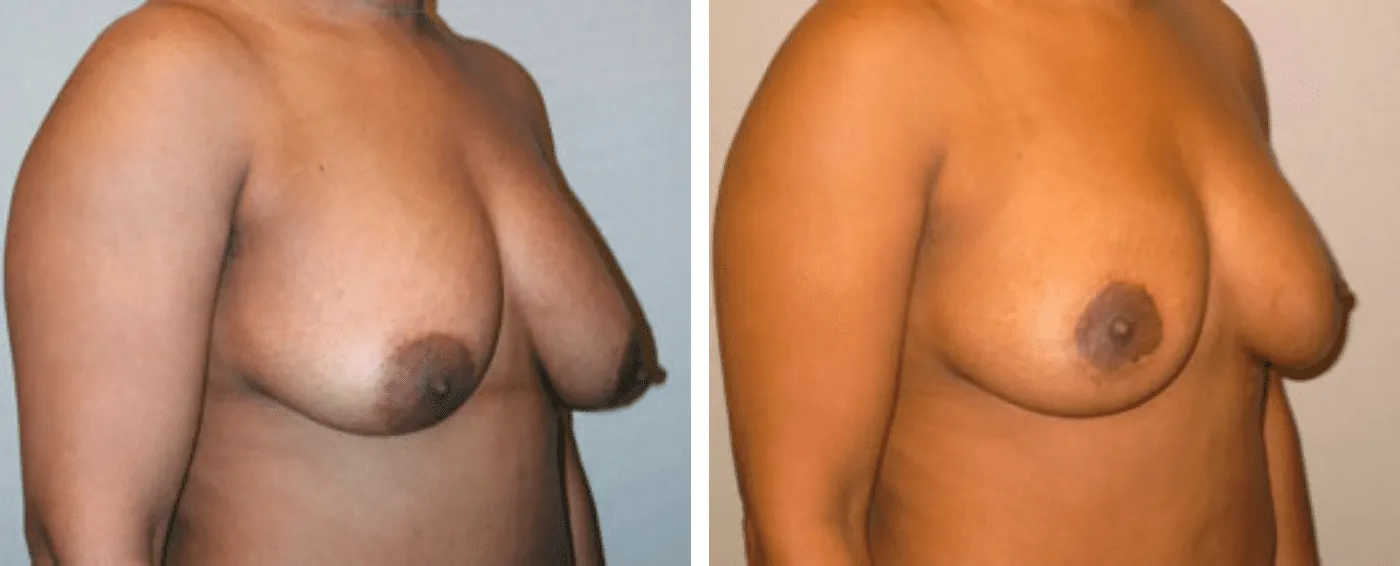 Breast lift b